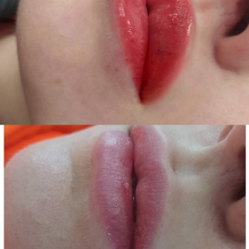 Контурна пластика
                    Лікар-косметолог Тетяна Луцьк