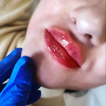 Контурна пластика
                    Лікар-косметолог Тетяна Луцьк