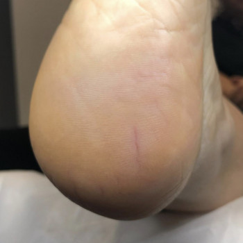 Після обробки тріщини