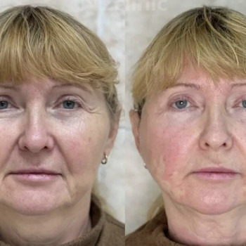 SMAS ліфтинг обличчя
                    Преподаватель курсов красоты Наталия Винница