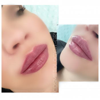 Збільшення губ