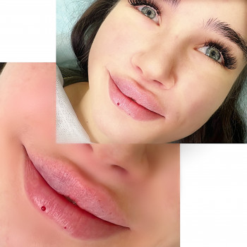 Збільшення губ
                    Косметолог-инъекционист Наталья Днепр