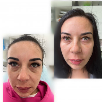 Коррекция # лица # средней трети #