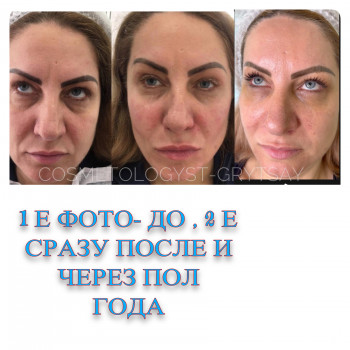 Коррекция средней трети лица+ 1 процедура биоревитализация з
