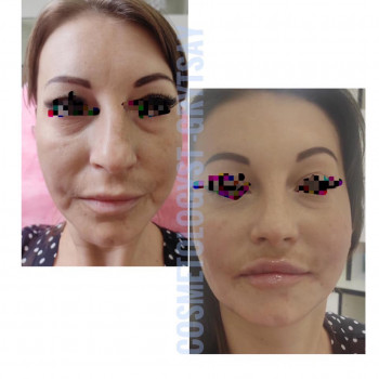 Коррекция средней трети лица + увеличение губ + ботулинотера