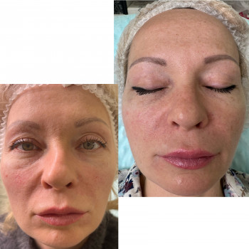 Коррекция средней трети лица