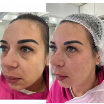 Коррекция средней трети лица