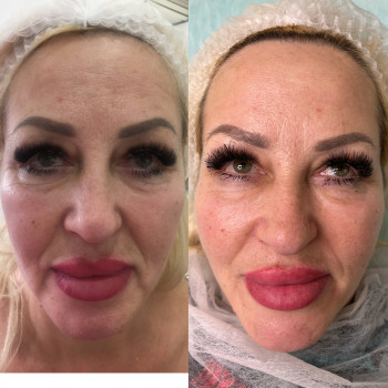 коррекция средней трети лица