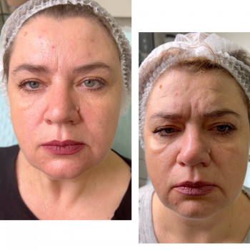 Фулфейс ботокс