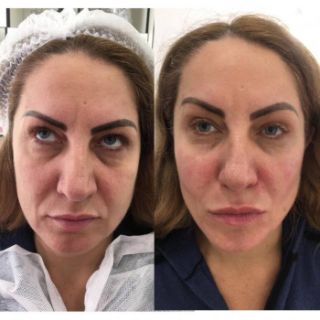 Корекція середньі третини