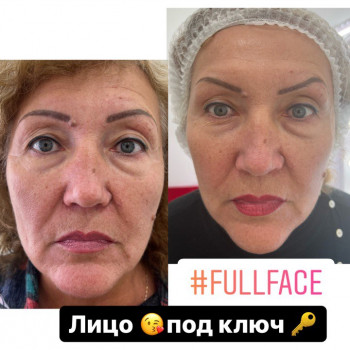 Фулфейс ботокс