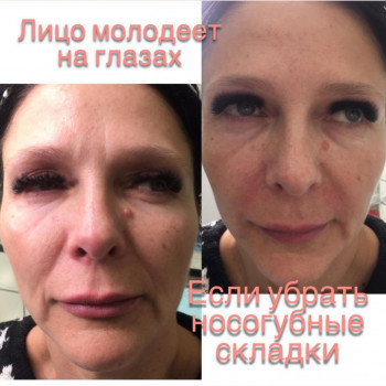 Заповнення носогубок