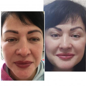 Фулфейс ботокс