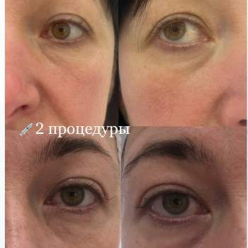 Мезотерапія зони очей
