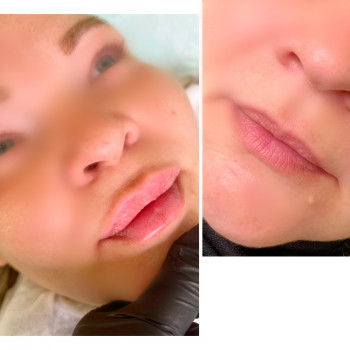 Губи корекція 1 мл