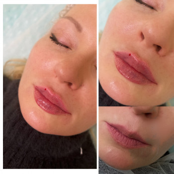 Корекція губ 1 мл