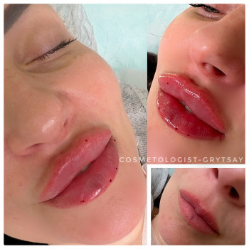 Корекція губ 2 мл