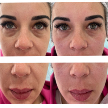 Корекція середньоі третини