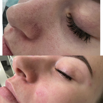 Чистка лица
                    Косметолог-инъекционист Наталья Днепр