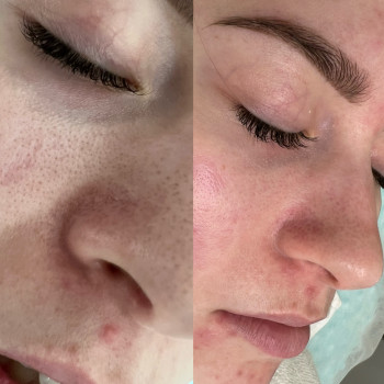 Чистка # обличчя # результат одразу