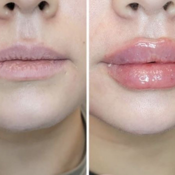 Увеличение губ
                    Косметолог-ін'єкціоніст Татьяна Вінниця