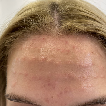 Біоревіталізація чоло-
Ціна 1500грн