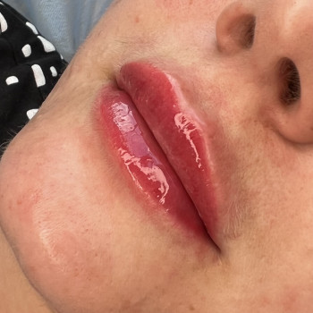 Увеличение губ
                    Косметолог-ін'єкціоніст Татьяна Вінниця