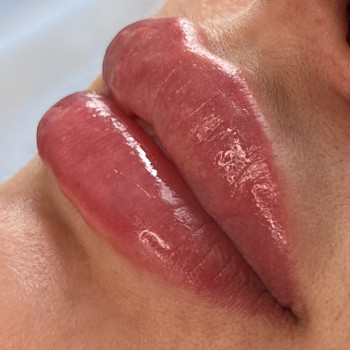 Увеличение губ
                    Косметолог-ін'єкціоніст Татьяна Вінниця