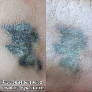 Слева чужое грубое удаление. Права наше удаление