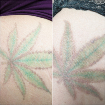 Лазер +ремувер