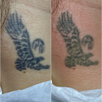 Сразу после. Без волдырей и рубцов