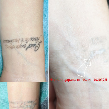 Лазерное удаление тату
                    Мастер перманентного макияжа Оксана Киев