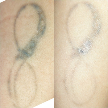 2 процедуры лу