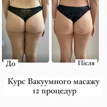 До/після 
Курс - апаратного вакуумного масажу ❤️