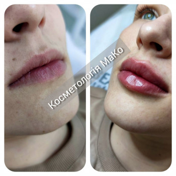 ін`єкційне збільшення губ в техніці Natural lips

   