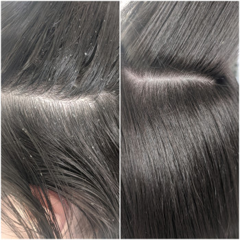 Пилинг кожи головы