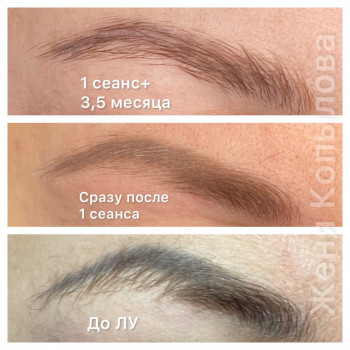 результат 1 процедуры + 3,5 месяца