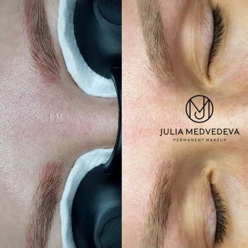 Лазерное удаление
                    Бровист Юлия Харьков