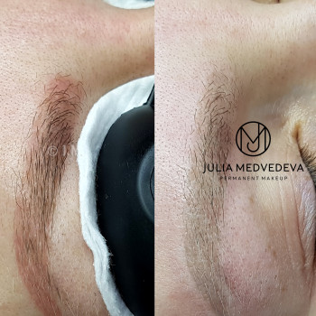 Лазерное удаление
                    Бровист Юлия Харьков