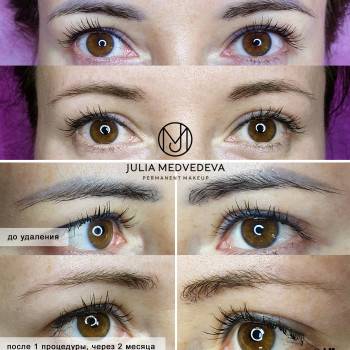 Лазерное удаление
                    Бровист Юлия Харьков