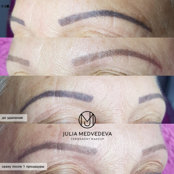 Лазерное удаление
                    Бровист Юлия Харьков