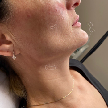 Углы Джоли, углы нижней челюсти, контурная пластика нижней трети
                    Косметолог Виктория Киев