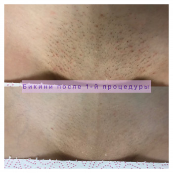 Результат зоны бикини