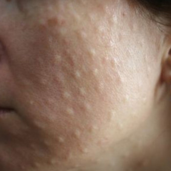 Мезотерапия любая зона
                    Косметолог-ін'єкціоніст Елена Київ