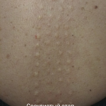 Мезотерапия любая зона
                    Косметолог-ін'єкціоніст Елена Київ