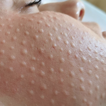 Биоревитализация любой зоны
                    Косметолог-ін'єкціоніст Елена Київ