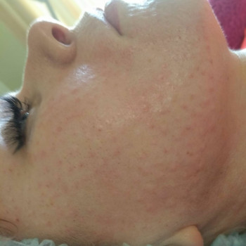 Биоревитализация любой зоны
                    Косметолог-ін'єкціоніст Елена Київ