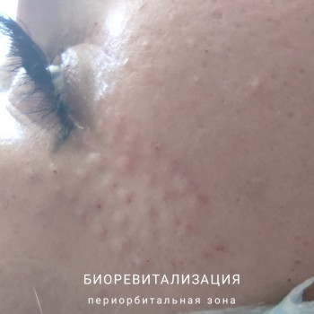 Биоревитализация любой зоны
                    Косметолог-ін'єкціоніст Елена Київ