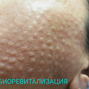 Биоревитализация любой зоны
                    Косметолог-ін'єкціоніст Елена Київ