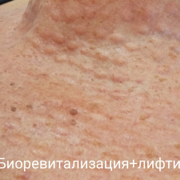 Биоревитализация любой зоны
                    Косметолог-ін'єкціоніст Елена Київ
